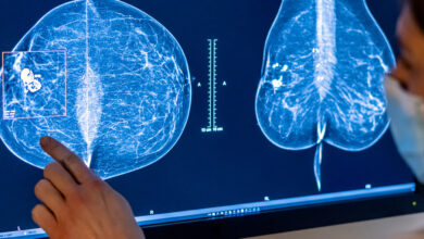 In Reversal, Expert Panel Recommends Breast Cancer Screening at 40