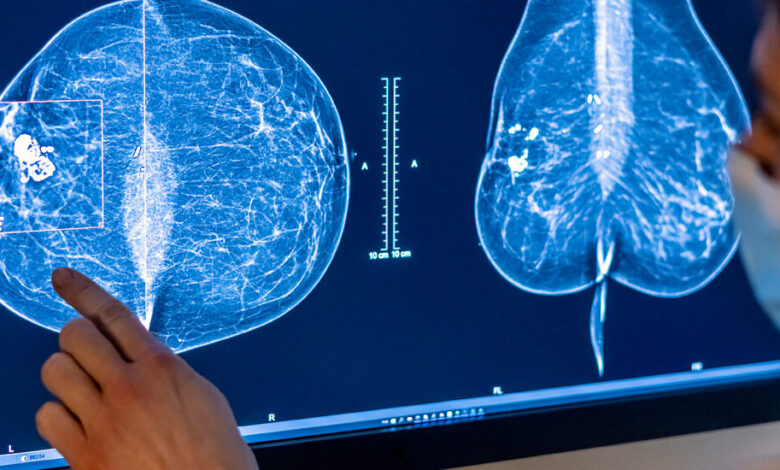 In Reversal, Expert Panel Recommends Breast Cancer Screening at 40 In Reversal, Expert Panel Recommends Breast Cancer Screening at 40