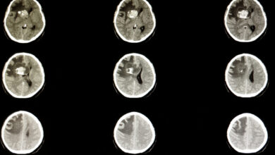 FDA gives nod to Day One’s drug for common childhood brain tumor