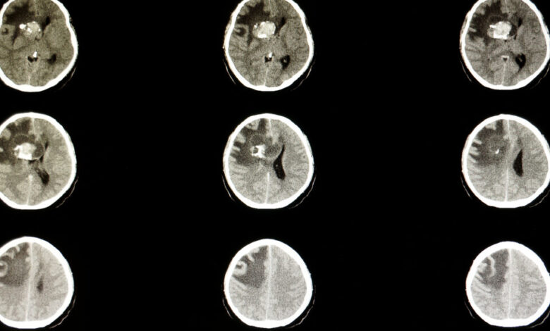 FDA gives nod to Day One’s drug for common childhood brain tumor FDA gives nod to Day One’s drug for common childhood brain tumor