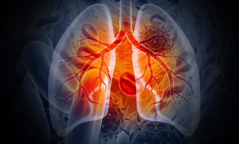 The Use of Artificial Intelligence in Lung Cancer Management The Use of Artificial Intelligence in Lung Cancer Management