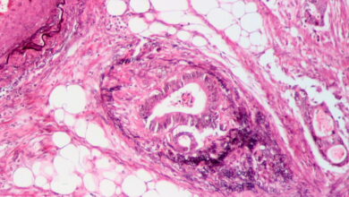 Gritstone Bio says personalized cancer vaccine falls short in key trial