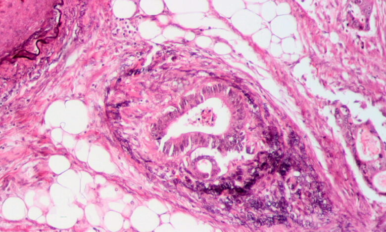 Gritstone Bio says personalized cancer vaccine falls short in key trial Gritstone Bio says personalized cancer vaccine falls short in key trial