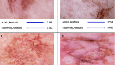 Artificial Intelligence-Based Distinction of Actinic Keratosis and Seborrheic Keratosis – Cureus