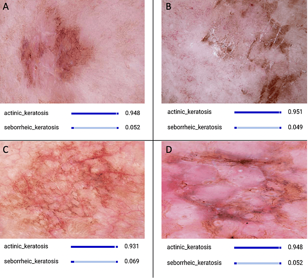 Artificial Intelligence-Based Distinction of Actinic Keratosis and