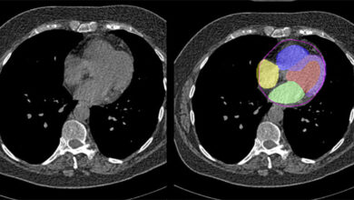 Artificial intelligence can evaluate cardiovascular risk during CT scan