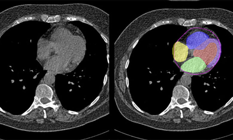 Artificial intelligence can evaluate cardiovascular risk during CT scan Artificial intelligence can evaluate cardiovascular risk during CT scan