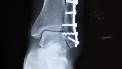 Artificial intelligence techniques can help clinicians assess and treat patients with bone fractures