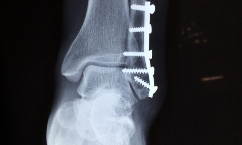 Artificial intelligence techniques can help clinicians assess and treat patients with bone fractures Artificial intelligence techniques can help clinicians assess and treat patients with bone fractures
