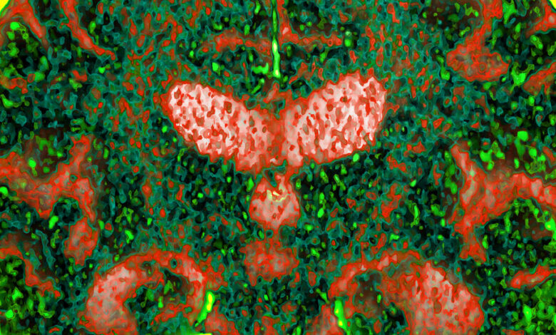 Study Suggests Genetics as a Cause, Not Just a Risk, for Some Alzheimers Study Suggests Genetics as a Cause, Not Just a Risk, for Some Alzheimers
