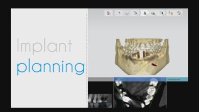 Dentists at UB using artificial intelligence to repair teeth