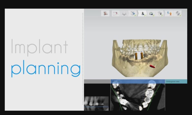 Dentists at UB using artificial intelligence to repair teeth Dentists at UB using artificial intelligence to repair teeth