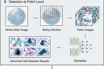 Artificial intelligence enables precision diagnosis of cervical cytology grades and cervical cancer