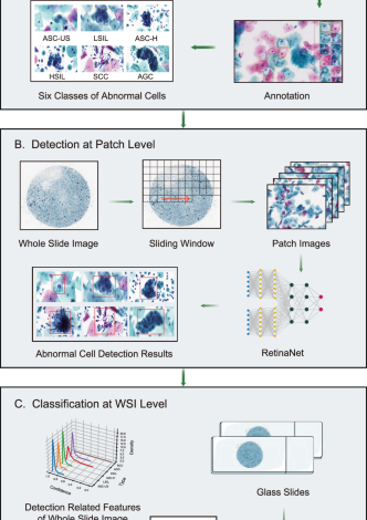 Artificial intelligence enables precision diagnosis of cervical cytology grades and cervical cancer Artificial intelligence enables precision diagnosis of cervical cytology grades and cervical cancer