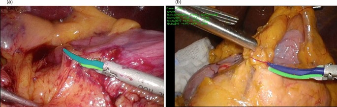 Laparoscopic distal gastrectomy skill evaluation from video: a new artificial intelligence-based instrument identification system Laparoscopic distal gastrectomy skill evaluation from video: a new artificial intelligence-based instrument identification system