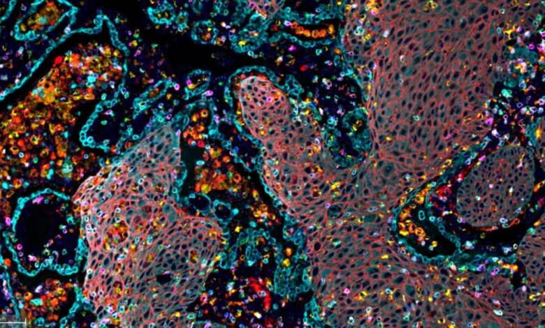 For one rare type of lung cancer, Pfizer pill reduces progression by 81% For one rare type of lung cancer, Pfizer pill reduces progression by 81%