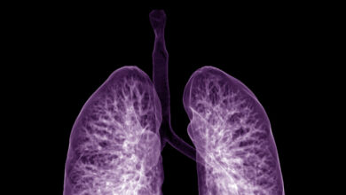 Insmed lung disease drug hits target in key Phase 3 trial