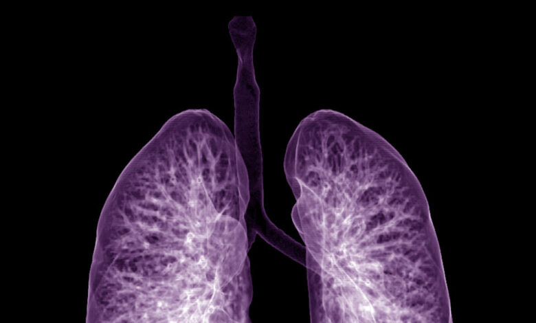 Insmed lung disease drug hits target in key Phase 3 trial Insmed lung disease drug hits target in key Phase 3 trial