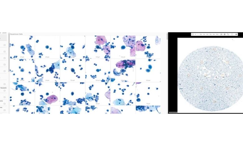 CorePlus Announces the Deployment of Artificial Intelligence Algorithm for 100% QC of Pap Tests CorePlus Announces the Deployment of Artificial Intelligence Algorithm for 100% QC of Pap Tests