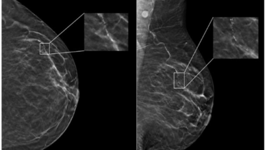 New Study Finds Age and Race Impact Artificial Intelligence (AI) Performance on Digital Mammograms