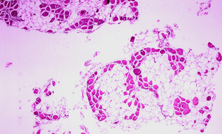 Duchenne drug from Nippon Shinyaku fails in rare confirmatory trial Duchenne drug from Nippon Shinyaku fails in rare confirmatory trial