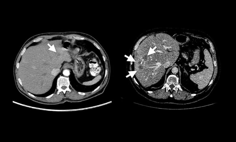 Johns Hopkins researchers create artificial tumors to help AI detect early-stage cancer Johns Hopkins researchers create artificial tumors to help AI detect early-stage cancer