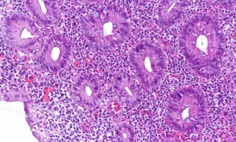 AltruBio raises 5 million to develop ulcerative colitis drug AltruBio raises 5 million to develop ulcerative colitis drug