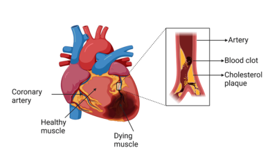 Advancements in Artificial Intelligence for Precision Diagnosis and Treatment of Myocardial Infarction: A … – Cureus