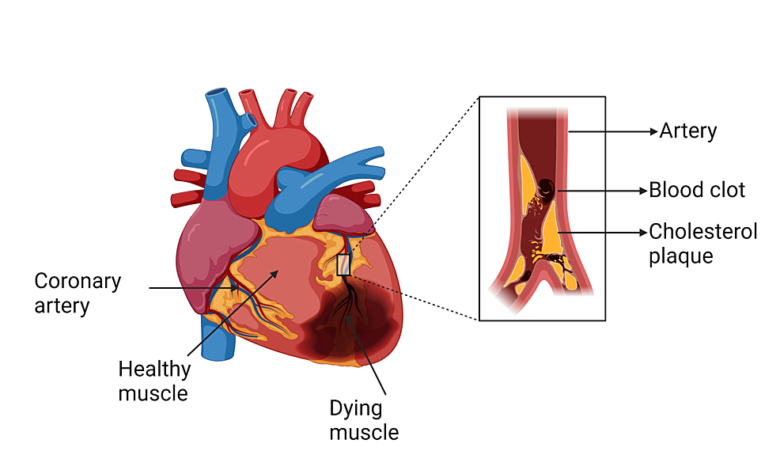 Advancements in Artificial Intelligence for Precision Diagnosis and Treatment of Myocardial Infarction: A … – Cureus Advancements in Artificial Intelligence for Precision Diagnosis and Treatment of Myocardial Infarction: A … – Cureus