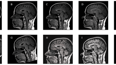 Use of Artificial Intelligence in the Prediction of Chiari Malformation Type 1 Recurrence After Posterior Fossa Decompressive Surgery