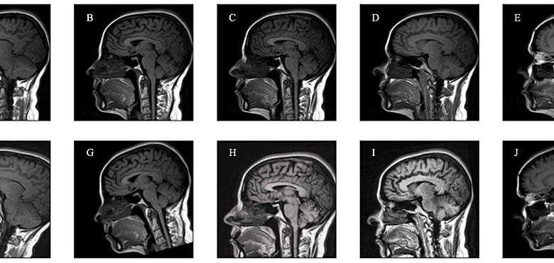 Use of Artificial Intelligence in the Prediction of Chiari Malformation Type 1 Recurrence After Posterior Fossa Decompressive Surgery