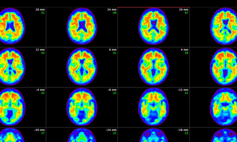 Advisory Panel of Experts Endorses F.D.A. Approval of New Alzheimer’s Drug Advisory Panel of Experts Endorses F.D.A. Approval of New Alzheimer’s Drug