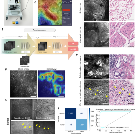 Artificial intelligence-based real-time histopathology of gastric cancer using confocal laser endomicroscopy Artificial intelligence-based real-time histopathology of gastric cancer using confocal laser endomicroscopy