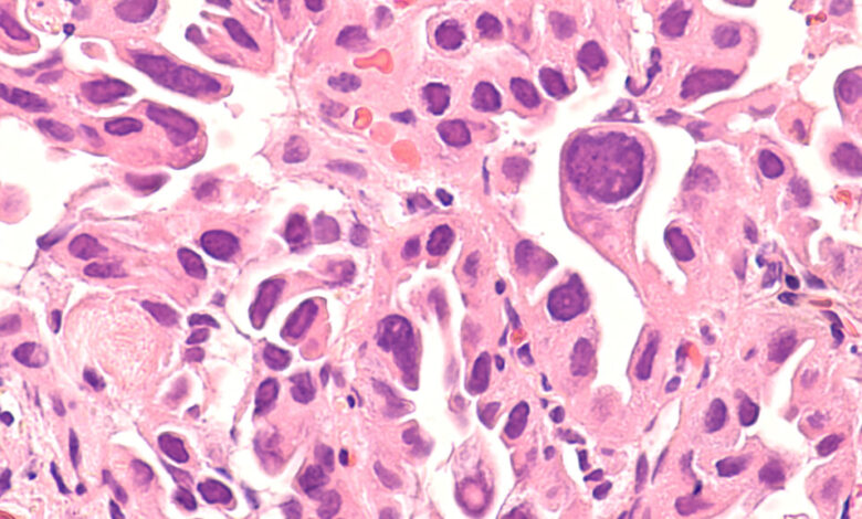Delfi Diagnostics unveils key aspects of liquid biopsy test for lung cancer Delfi Diagnostics unveils key aspects of liquid biopsy test for lung cancer