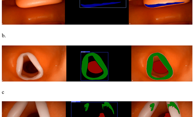 Glottis Recognition Software Development Using Artificial Intelligence – Cureus